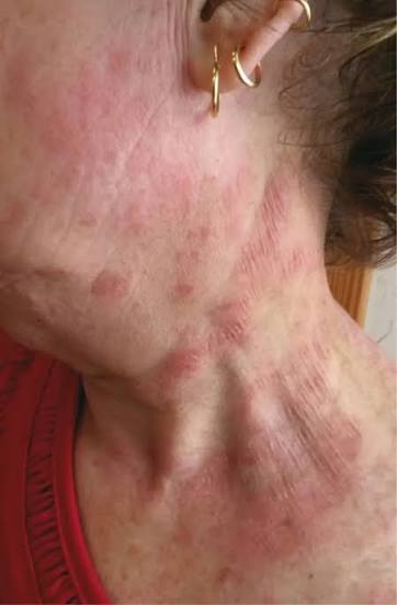 Atopic-Dermatitis